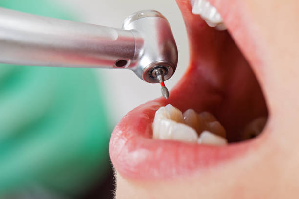 Best Emergency Dentist for Lost Fillings or Crowns in West Lafayette, IN